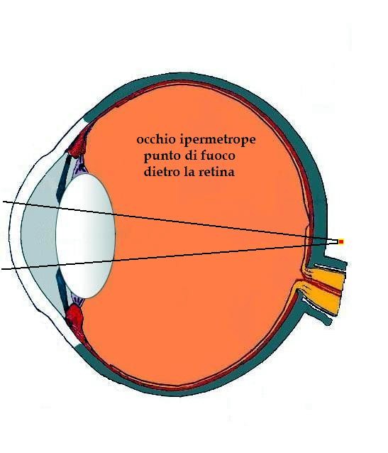 immagine di un occhio ipermetrope